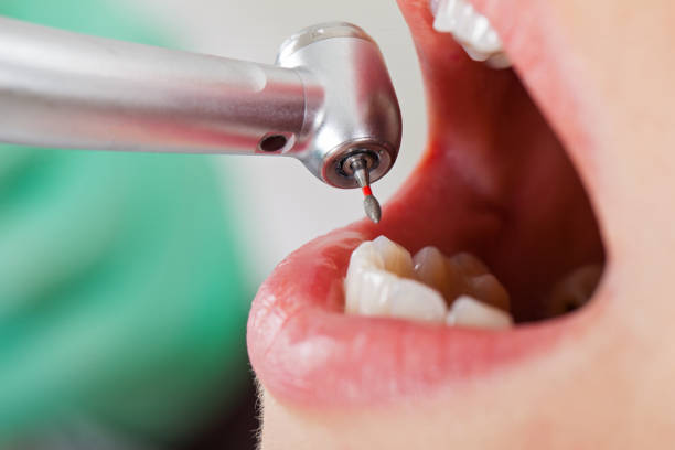 Best Emergency Wisdom Teeth Removal in Coronita, CA